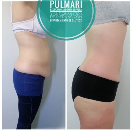 Tratamiento reductivo abdomen-espalda-flancos o Levantamiento de glúteos-anticelulitis piernas